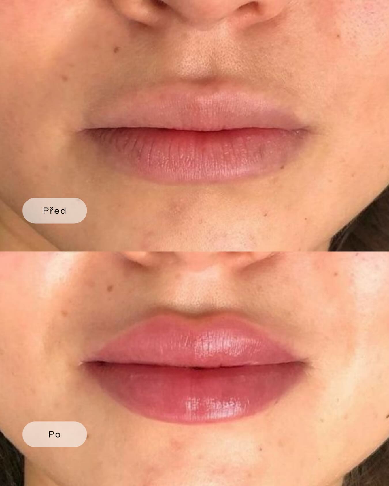 Lippenvergroesserung