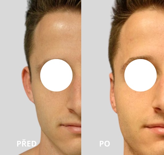 Otoplastik (Ohrenkorrektur)