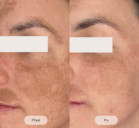 Pigmententfernung mit fraktionalem CO2-Laser
