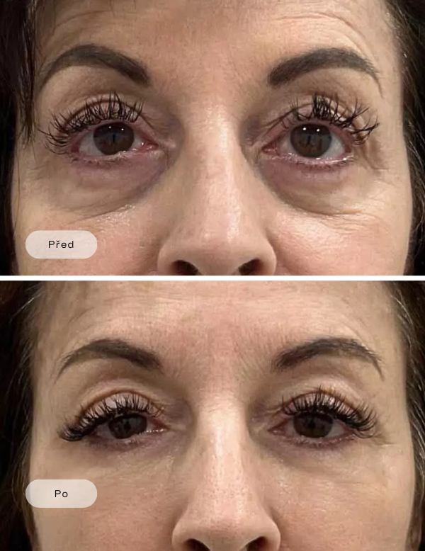 Filler fuer Augenringe (mit Hyaluronsaeure)