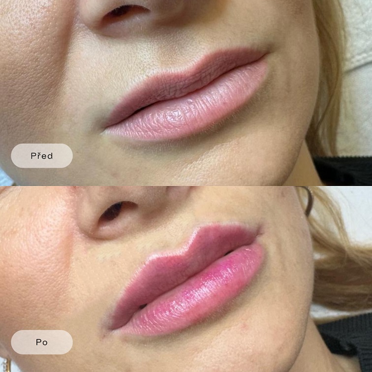 Wie vergrößert man die Lippen: Von natürlichen Tricks bis zu professionellen Eingriffen