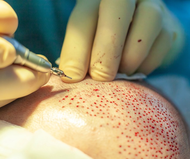 Haartransplantation: Was ist das und wie lange hält sie?