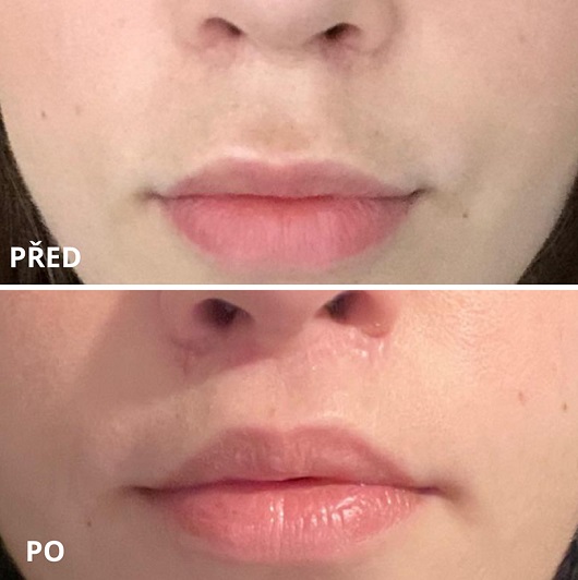 Lip Lift