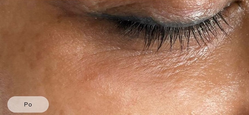 After procedure