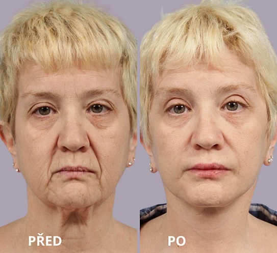 Facelift (Facial Plastic Surgery)