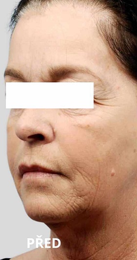 Before procedure