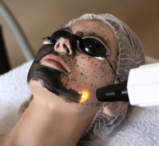 Carbon Peeling