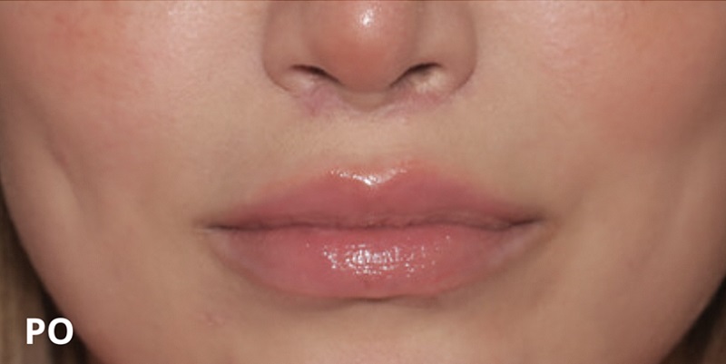 After procedure