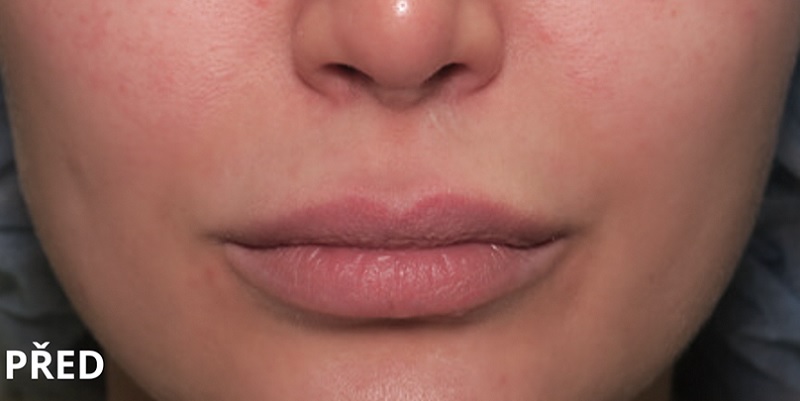 Before procedure