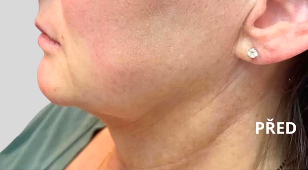 Before procedure