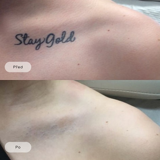 Tattoo Removal