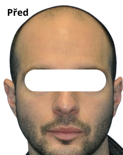 Before procedure