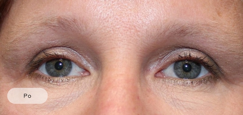 After procedure