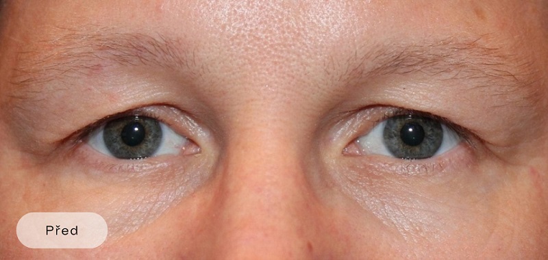 Before procedure