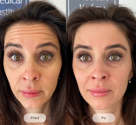 Injectable Wrinkle Removal: How Does It Work and How Long Do the Effects Last?