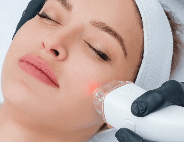 Laser Acne Treatment