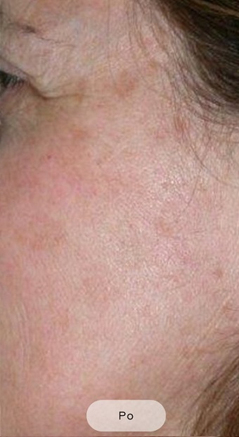 After procedure