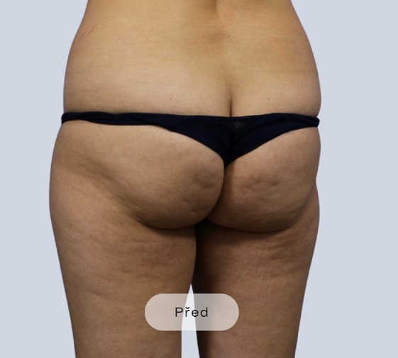 Before procedure