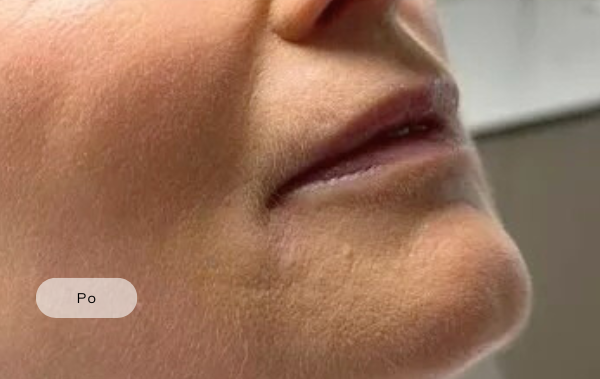 After procedure