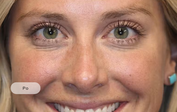After procedure