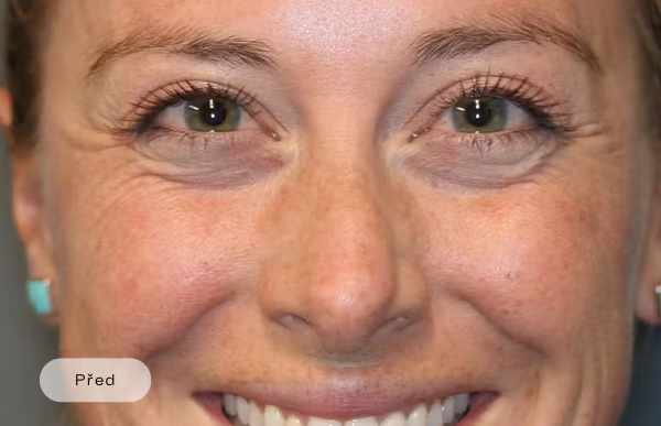 Before procedure