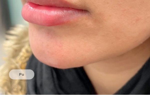 After procedure