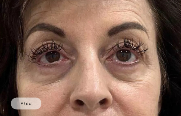 Before procedure