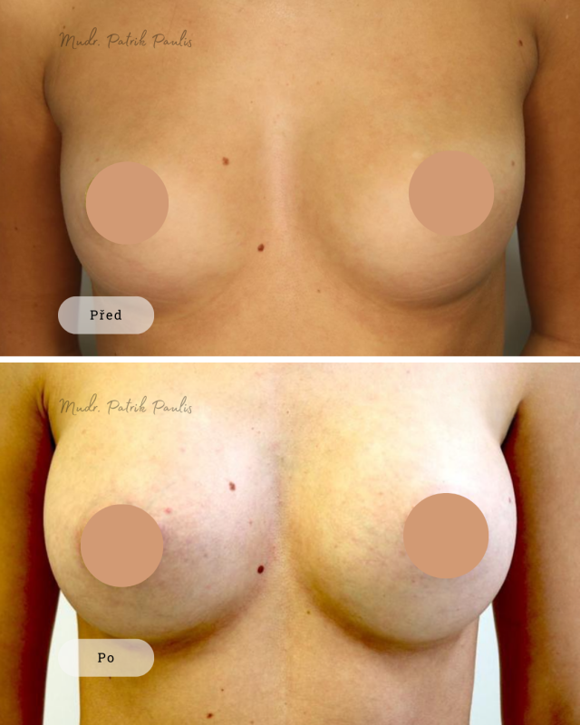 Breast Augmentation (Breast Enlargement)