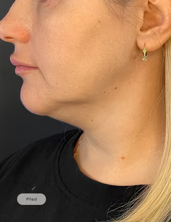 Before procedure