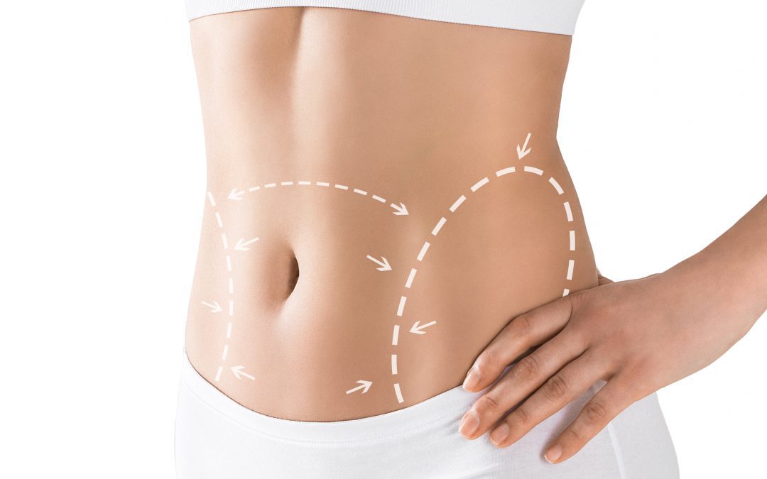 Abdominoplastika