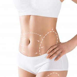 Abdominoplastika
