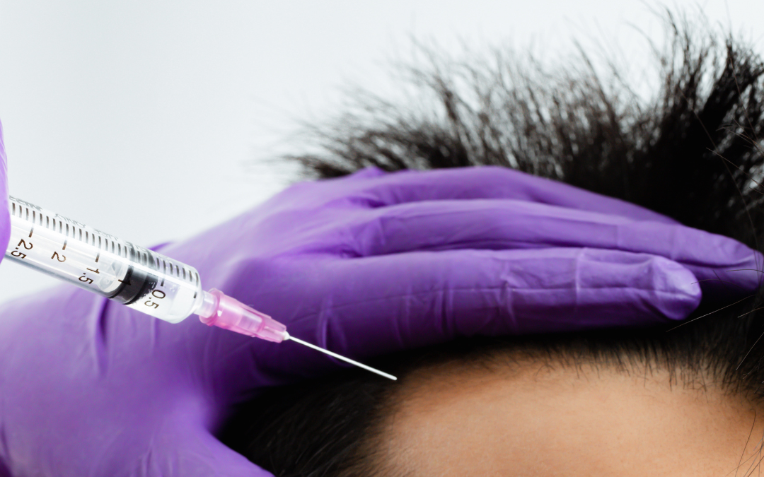 Padání vlasů – mezoterapie