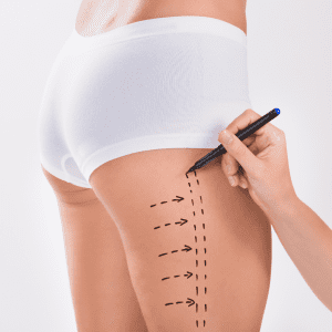 Liposukce