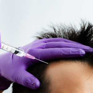 Padání vlasů – mezoterapie