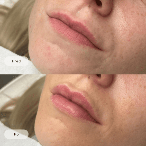 Přirozené zvětšení rtů s kyselinou hyaluronovou (1ml)
