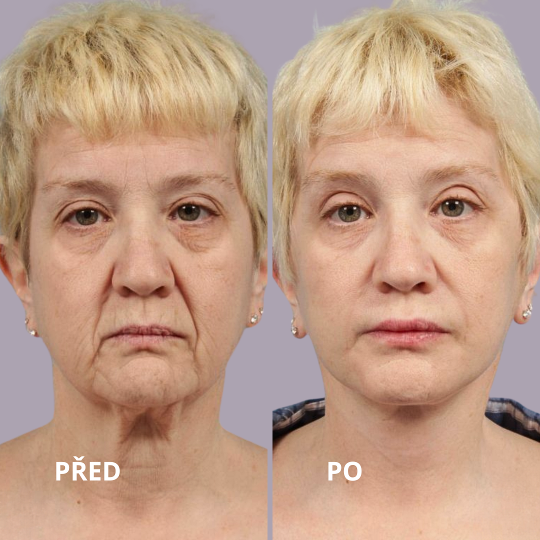 1FaceLift v Medical Institut v Plzni. FaceLift v Medical Institut v Plzni.