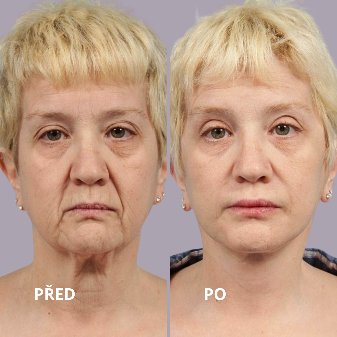 FaceLift v Medical Institut v Plzni.