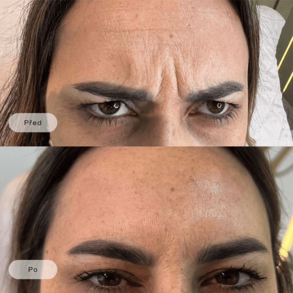 Zbavte se vrásek s BTX - glabela, čelo a vrásky kolem očí