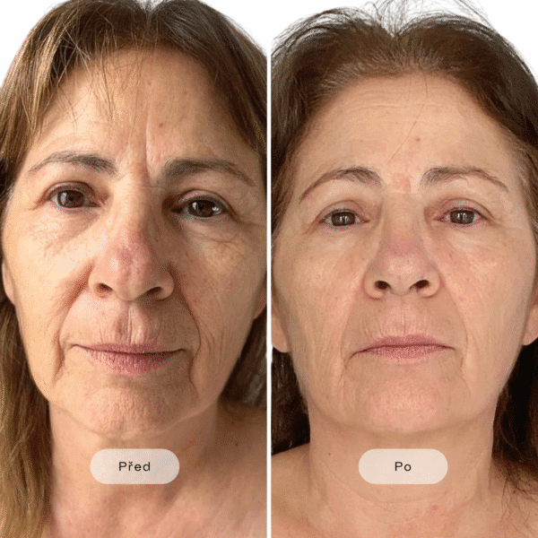 Viditelné omlazení s Ultrasound HIFU