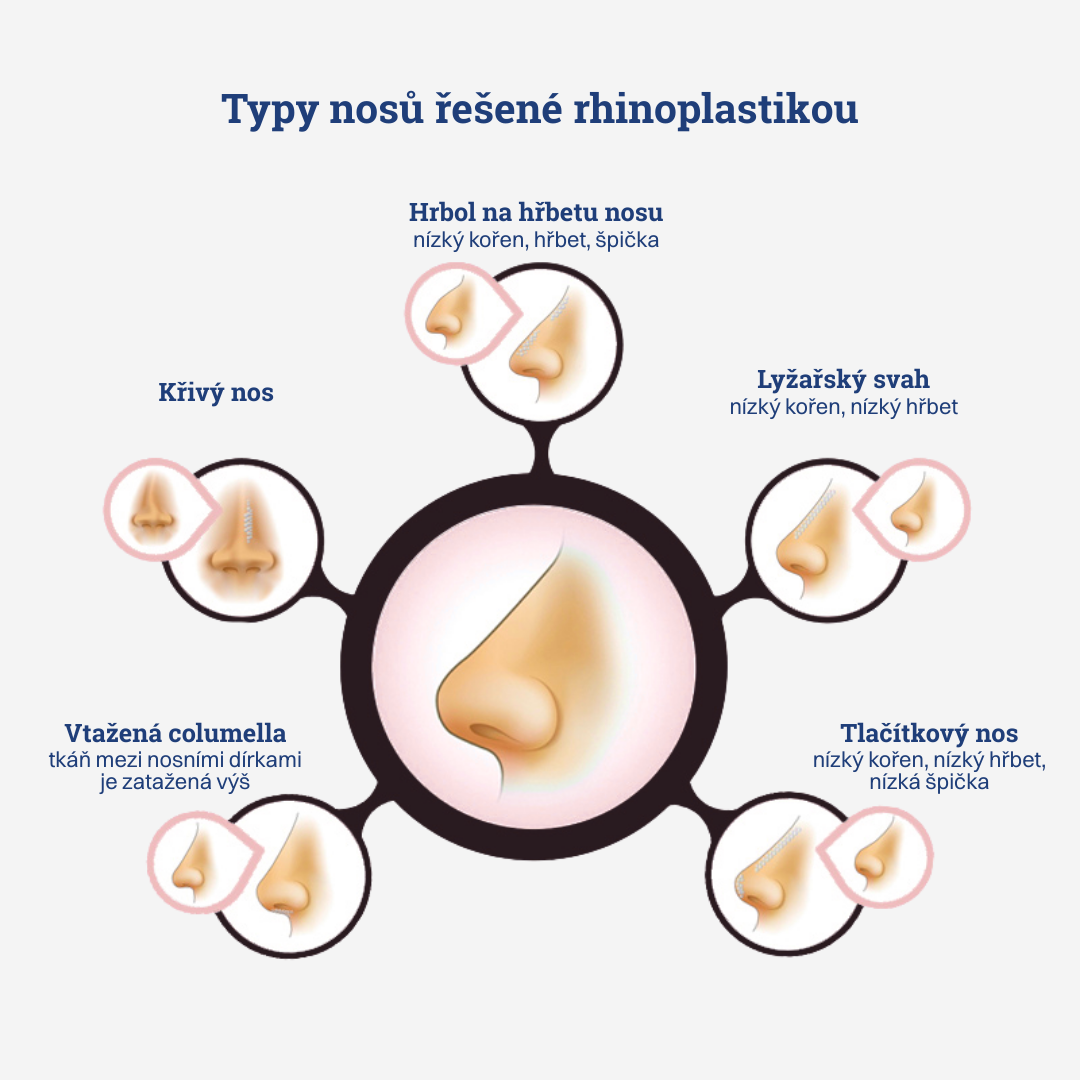 Rhinoplastika