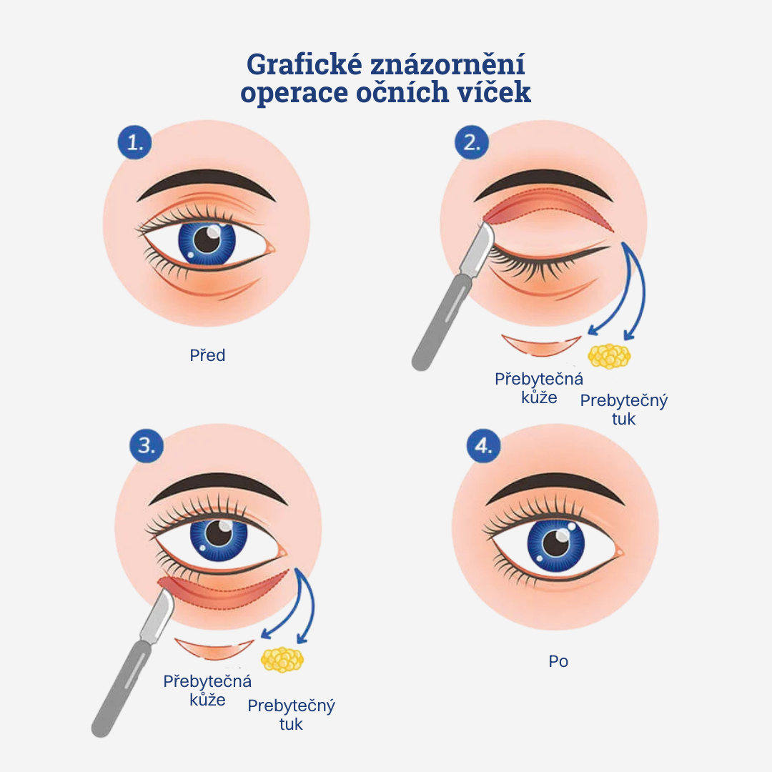 Operace očních víček - Blepharoplastika
