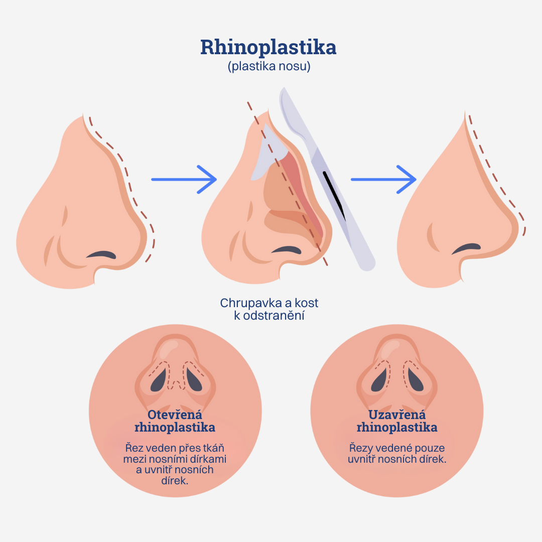 Rhinoplastika